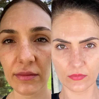 Melasma_before_and_after_1_600x600 (1)